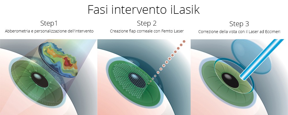 Fase intervento iLasik