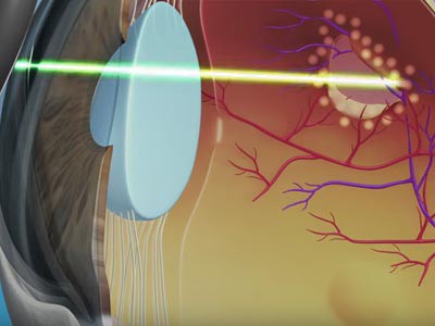 Interventi Laser Retina